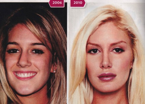 heidi montag before and after. heidi montag before and after