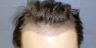 FUE hair transplant Islamabad