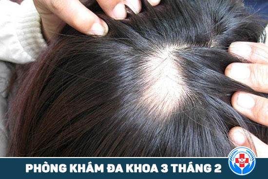 Ngăn ngừa tóc rụng bằng chất sắt và protein