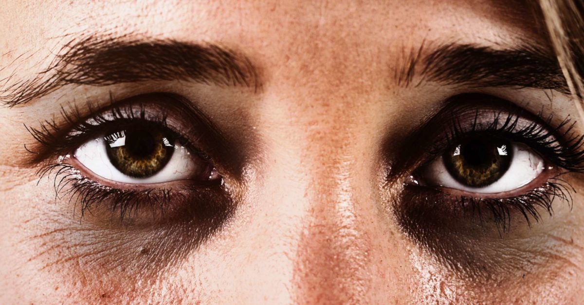 Dark Circles Remedy: Use these 5 things and get rid of dark circles forever
