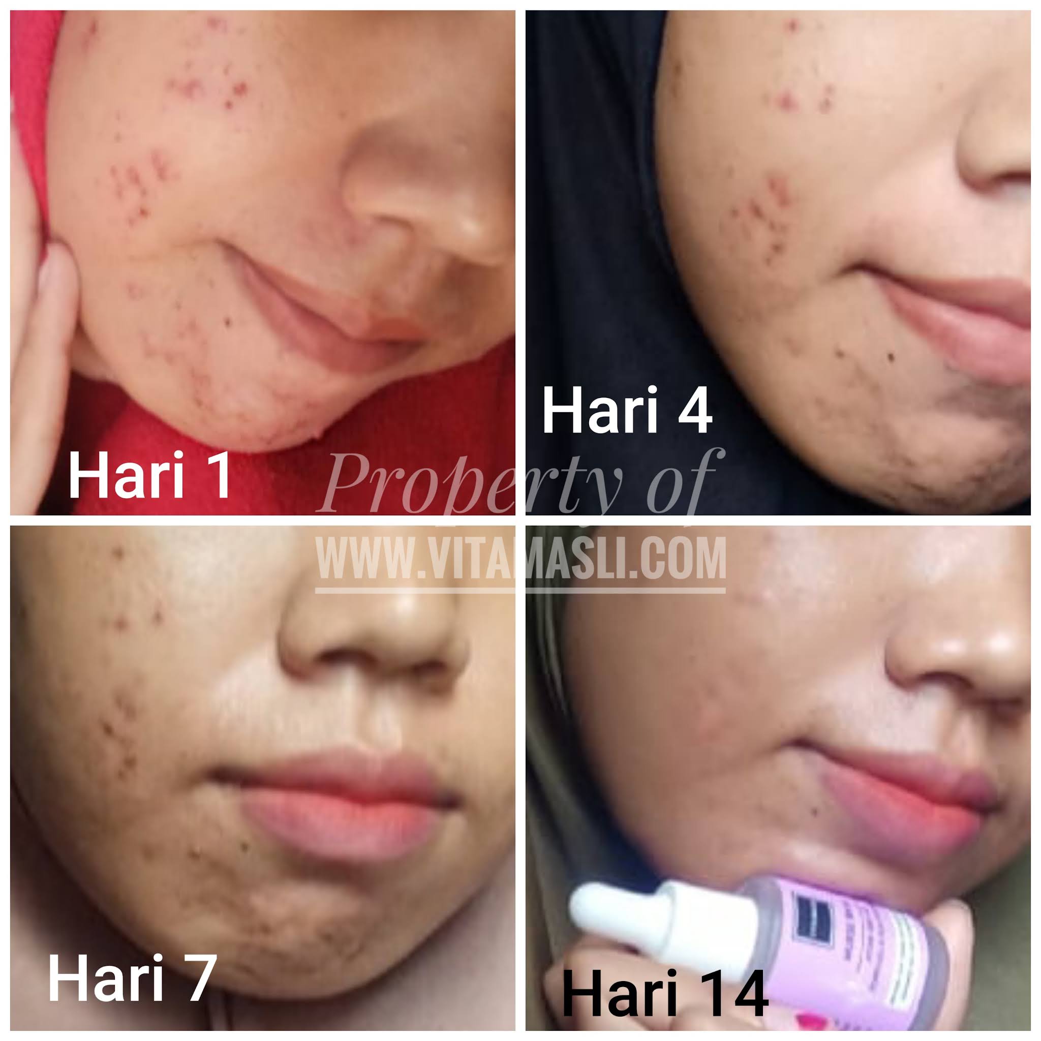 Efek Scarlett Whitening Acne Menyembuhkan jerawat