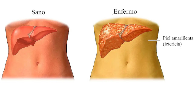 Higado_sano_y_enfermo