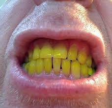 Can yellow teeth become white again?