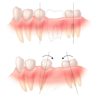 Tư vấn nhổ răng số 6 bị sâu an toàn nhất