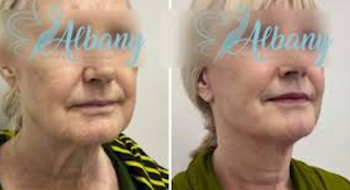 Facelift wіth Laser Skin Treatments