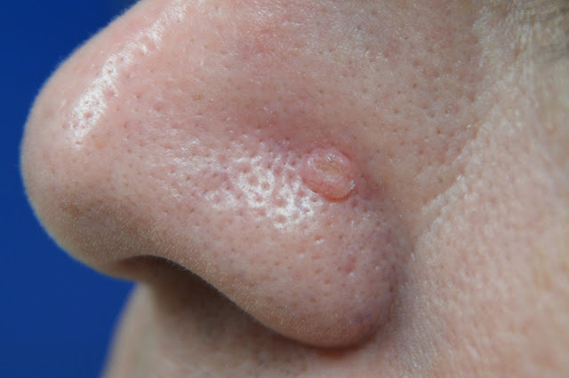 Figure 3: Basal Cell Carcinoma on the nose with telangiectasias and rolled borders