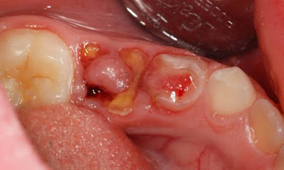 Xử lý răng sâu hay bị chảy máu theo cách an toàn-1