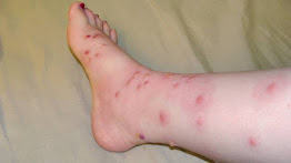 Pharmacotherapy of poison oak rash