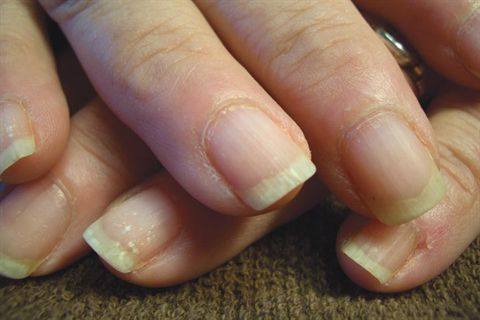 What Causes Dry Brittle Nails