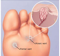 Plantar Warts