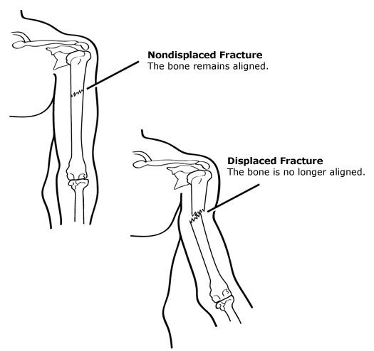 What is Displaced Fracture - Types Of Displaced Fractures - Displaced Fracture Symptoms , Causes - Displaced Fracture Treatment