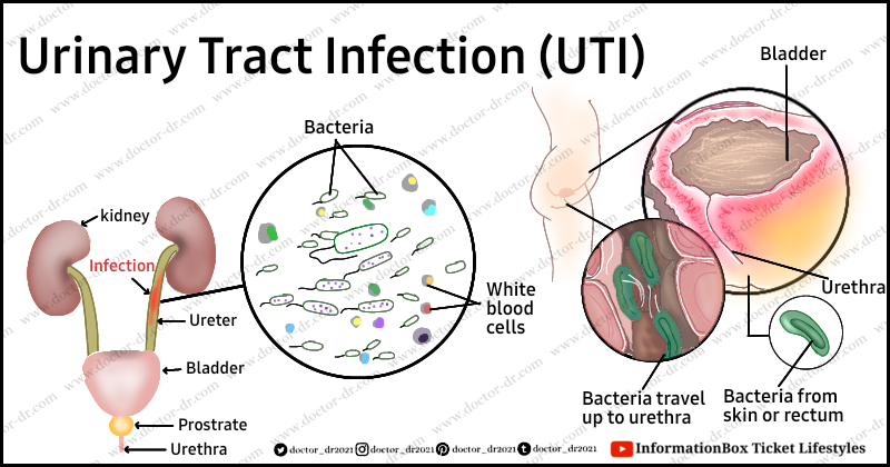 Urinary Tract Infection (UTI)