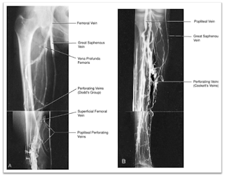 BELAJAR RADIOLOGI INTERVENSI Prosedur Phlebography