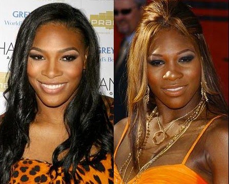 free serena williams plastic surgery