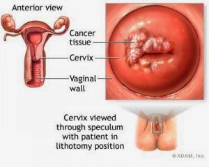 tumor Rahim stadium 2, obat kanker rahim, pengobatan kanker rahim