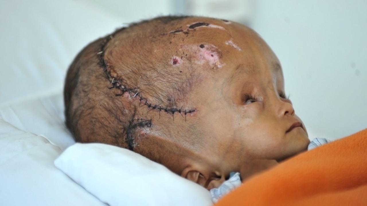 Doctors Shrink Head of Baby with Swollen Skull 