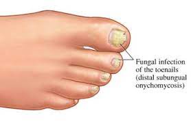 Internal factors contributing to toenail fungus