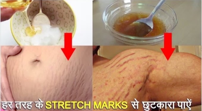 Stretch Marks remove after pregnancy at home/ स्ट्रेच मार्क्स 