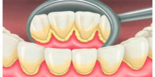 placa dental