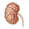 insuficiencia renal crónica