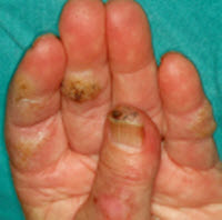 About Wart Removal And Treatment: October 2010