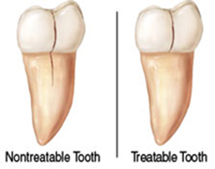 Răng bị dan nứt lớn không thể phục hồi