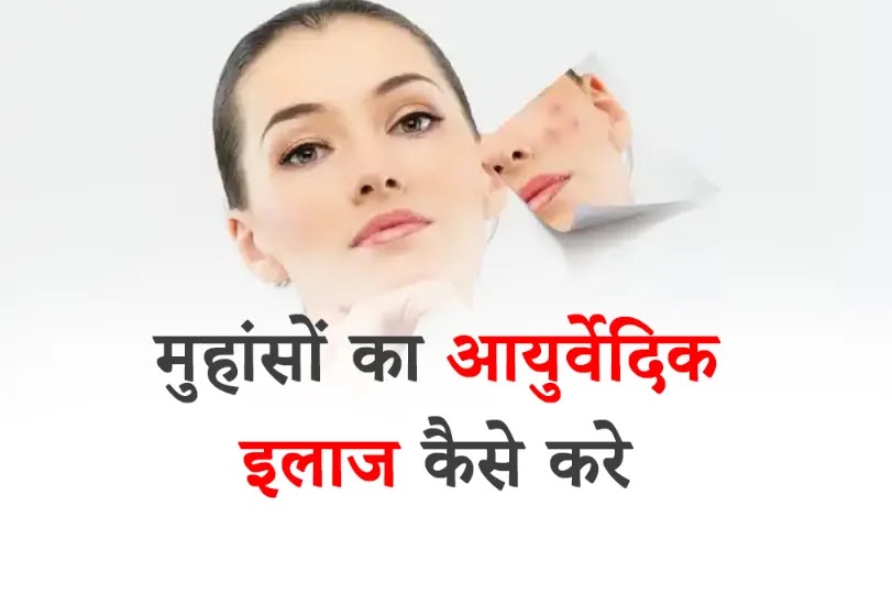 Ayurvedic Treatment for Pimples in Hindi
