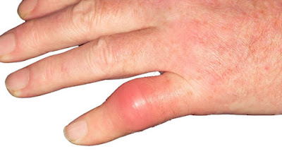 điều trị gout hiệu quả