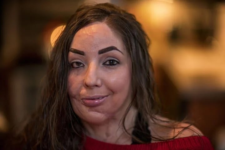 Domestic Ab-Use Survivor Nearly Di-Es As Ex A-Ttacks Her With Hot Grease A-Ttack