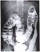 Barium enema double contrast