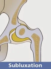 Alt="Displasia y portabebés ergonómicos de tela"