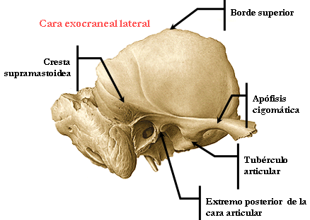 Exocraneal temporal bone lateral face