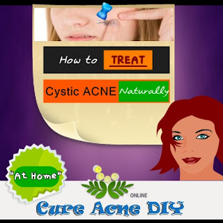 How to cure cystic acne at home naturally 