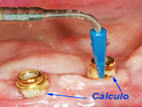 <Img src ="cálculo-alrededor-implante-dental.jpg" width = "400" height "300" border = "0" alt = "Tartrectomía alrededor de implante dental con sarro.">
