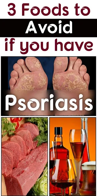 3 Foods to Avoid if you have Psoriasis