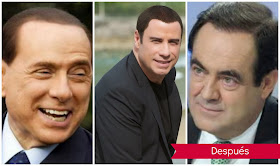 implantes y trasplantes capilares: Silvio Berlusconi, John Travolta, José Bono