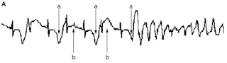 T-wave alternans