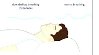 Management Of Sleep Apnea