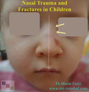 Nasal trauma and fractures in children