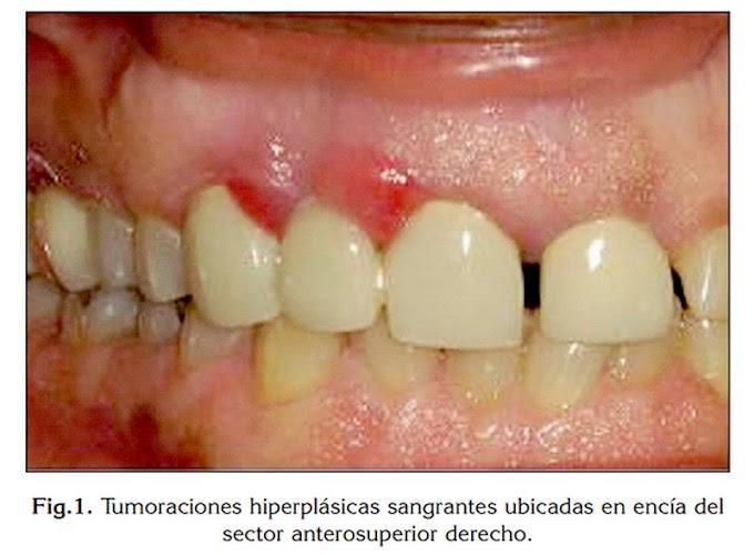 PDF: Granuloma telangiectásico en cavidad oral