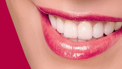 Hiệu quả của miếng dán trắng răng là gì?