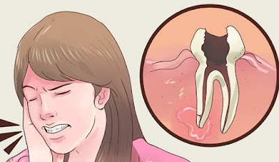 10 Obat Sakit Gigi Tradisional Mudah Dibuat Dan Ampuh