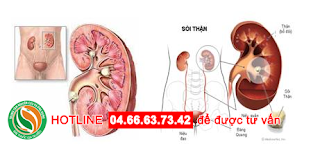 Điều trị sỏi thận ở bệnh viện nào hiệu quả?