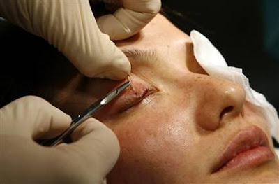 Eye Bag Removal Surgery (Blepharoplasty)