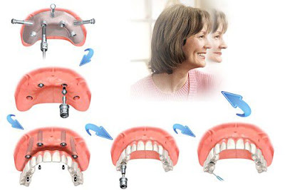 5 lợi ích tuyệt vời của trồng răng Implant