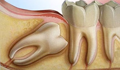 Nguyên nhân đau răng hàm trong cùng