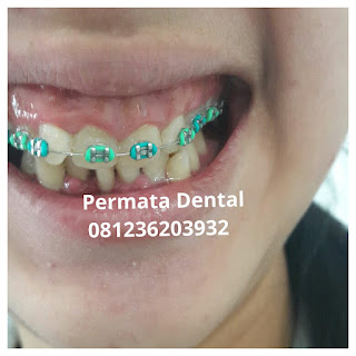 gambar foto behel bracket kawat gigi sebelum dan sesudah perawatan untuk memperbaiki merapikan gigi gingsul gigi miring renggang tonggos berantakan keluar masuk jarang diastema maju mundur tidak rapi tidak beraturan bali denpasar banyuwangi jember tidak rata kocar kacir