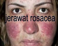 jerawat rosacea