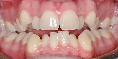 Răng lệch nhiều có bọc sứ được không?