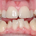 Phương pháp khắc phục hiệu quả răng lệch nhiều